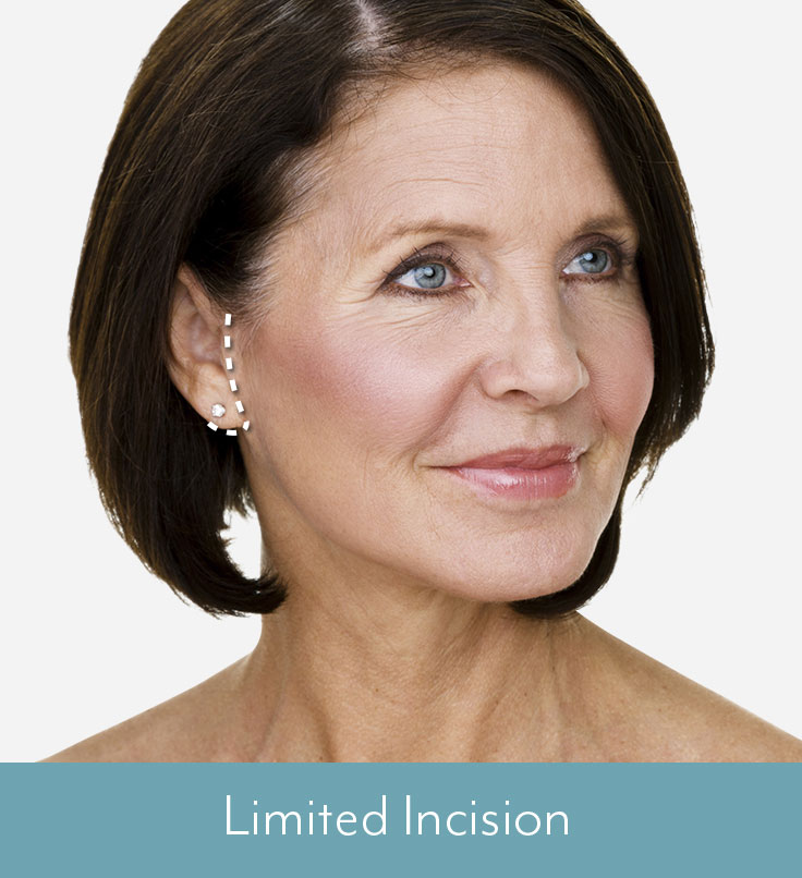 Facelift in Boston Limited Incision