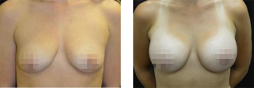 Crisalix Patient Before and After Treatment