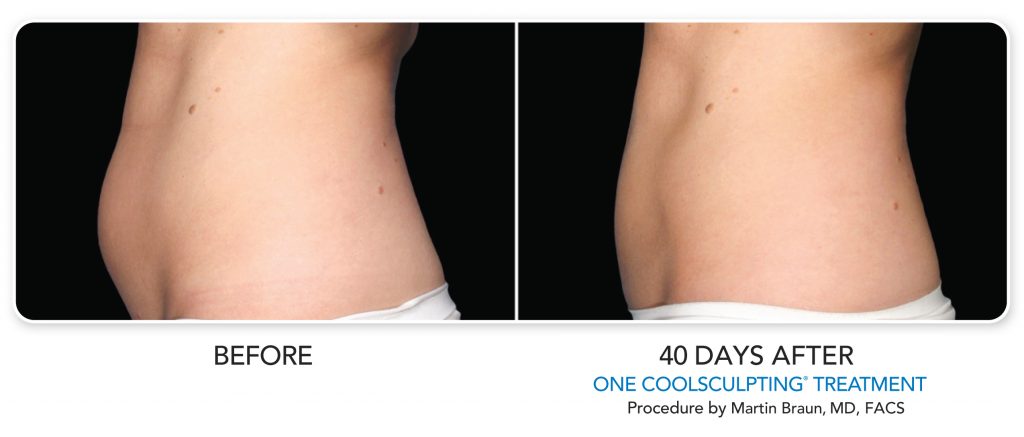 CoolSculpting in Boston before and after photos showing flatter abdomen from side 40 days after treatment