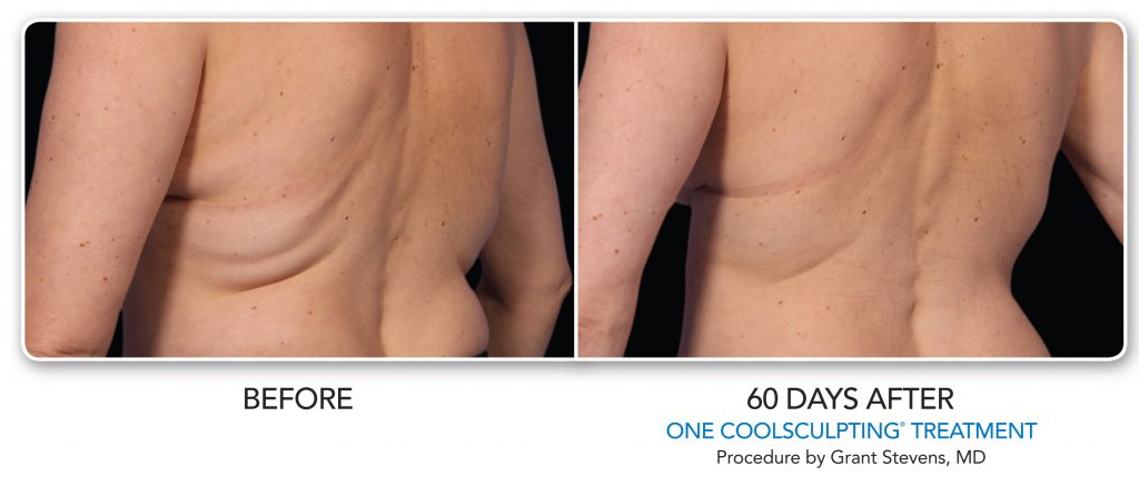 CoolSculpting before and after photos of contoured love handles