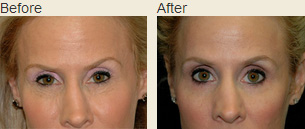Surgery To Make Your Eyes Bigger - Can Upper Eyelid Surgery Actually