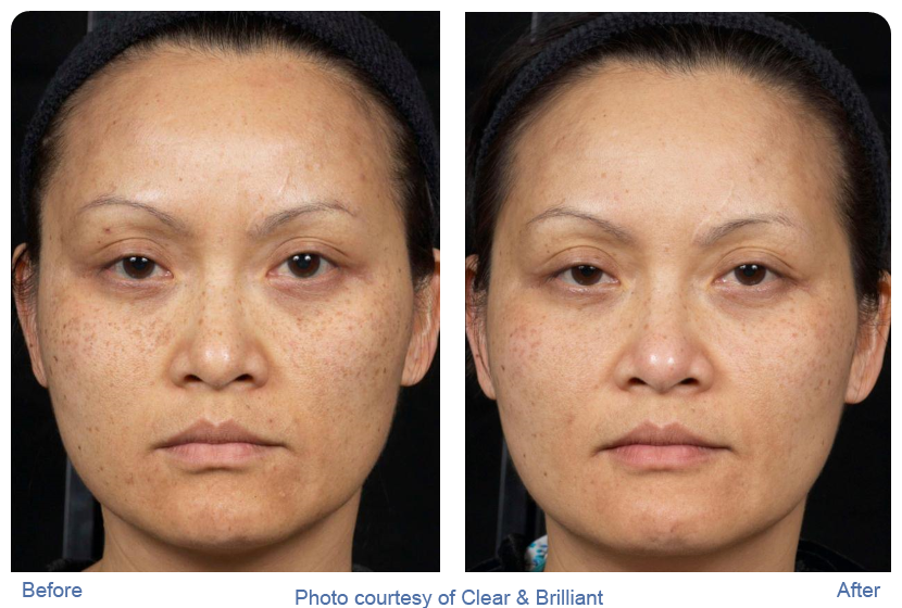 Clear and brilliant before and after photos showing asian woman with reduced sun spots