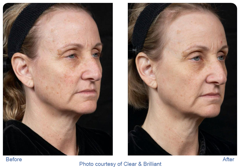 Clear and brilliant before and after photos showing older woman with reduced age spots