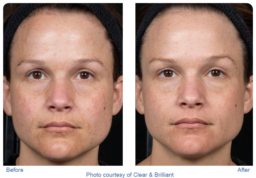 Clear and brilliant before and after photos showing young woman with clearer complexion