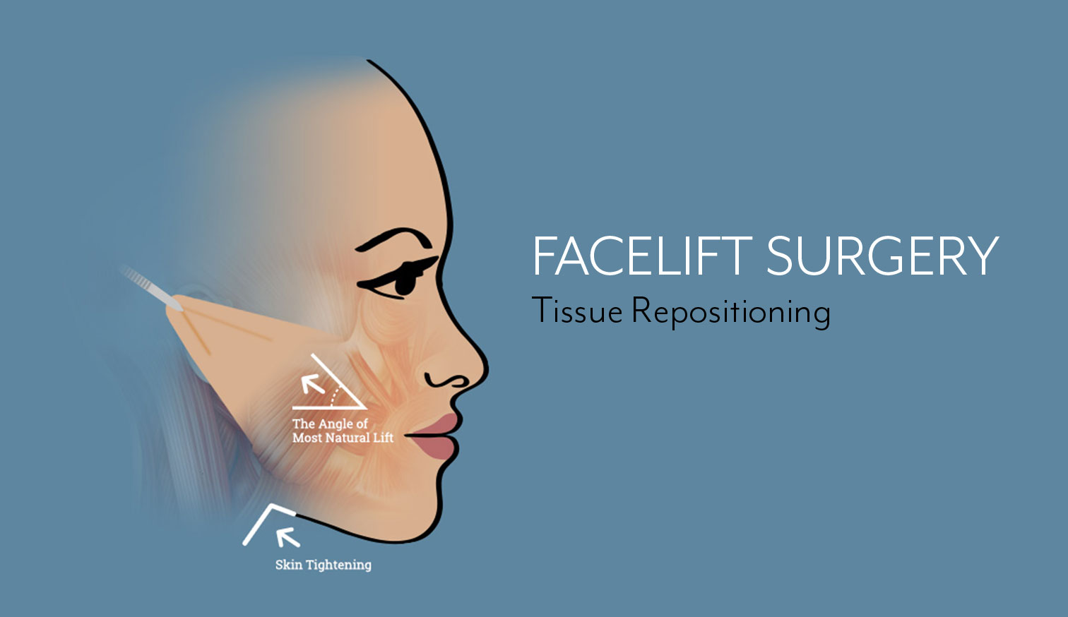 Facelift in Boston Tissue Repositioning Graphic