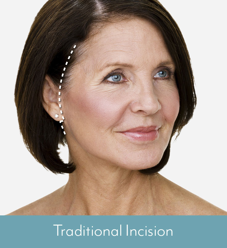 Facelift in Boston Traditional Incision