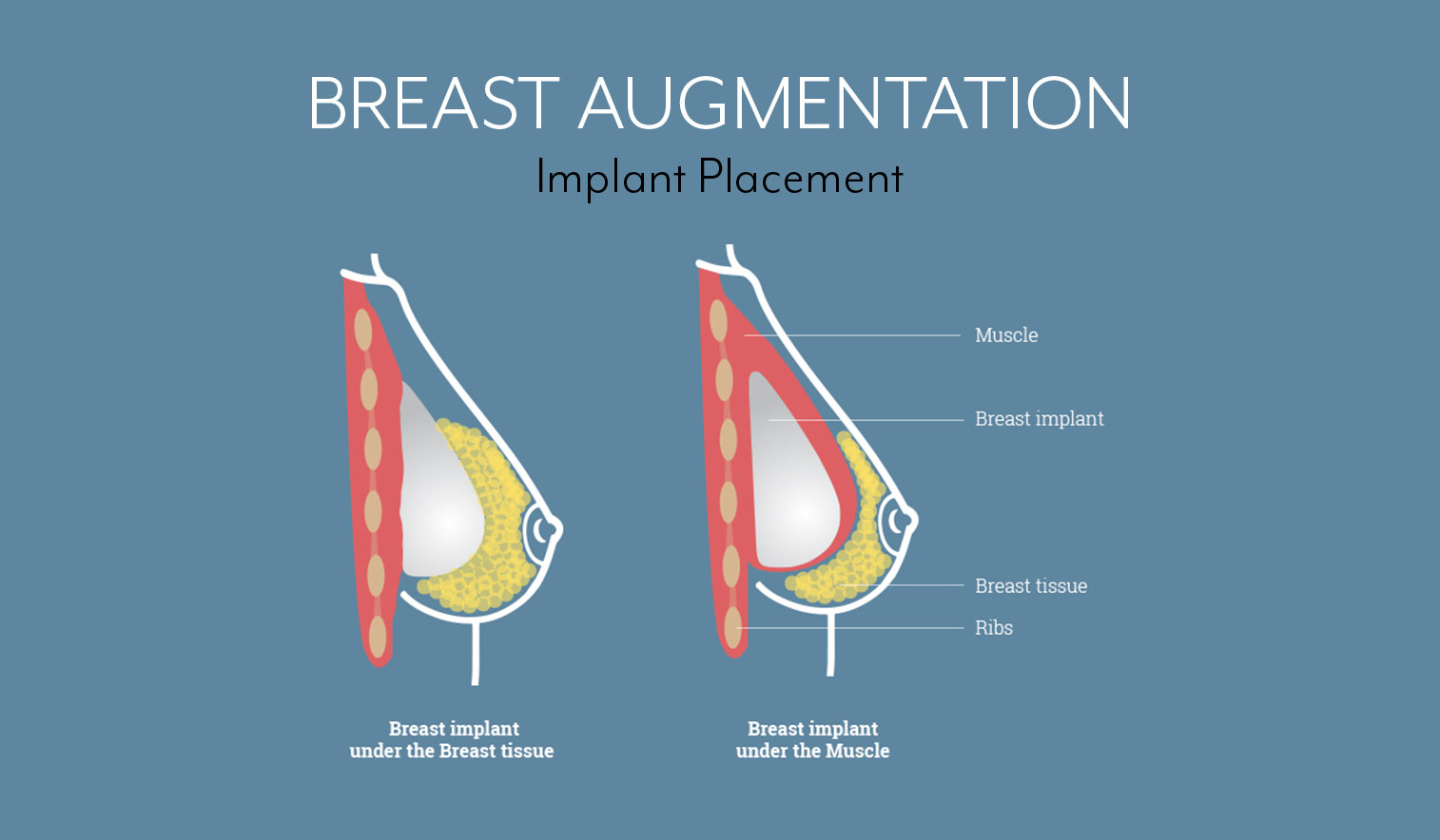 Breast Augmentation in Boston Implant Placement Graphic