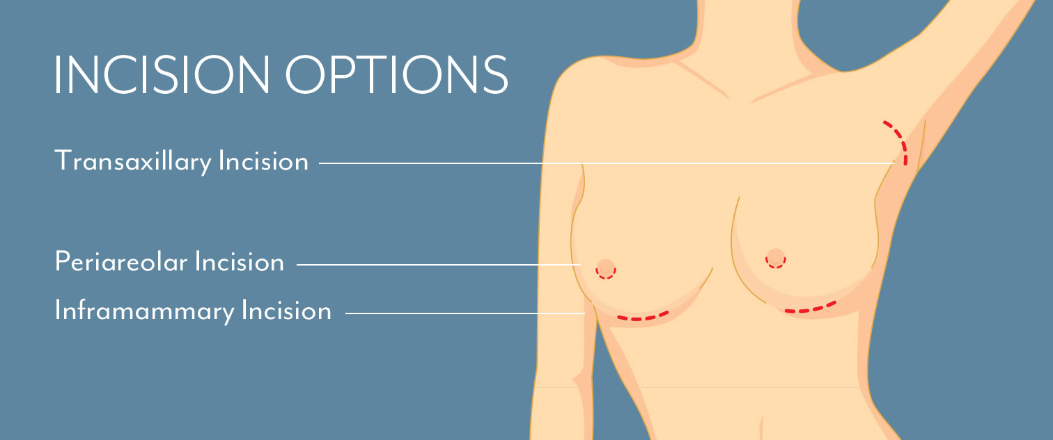 Graphic showing breast augmentation incision options at our Boston plastic surgery practice