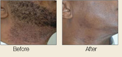 Laser hair removal before and after photos profile view showing hair removed from man's face
