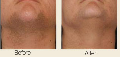 Laser hair removal before and after photos showing hair removed from below chin