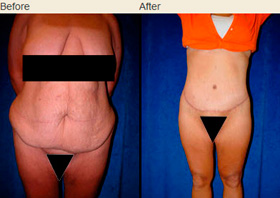 Lower body lift before and after photos showing removal of massive amount of skin