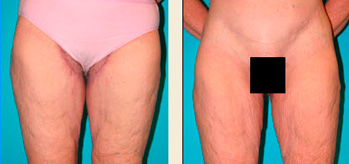 thigh lift before and after photos of actual patient in Boston