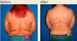 Upper body lift before and after photos showing actual patient's back