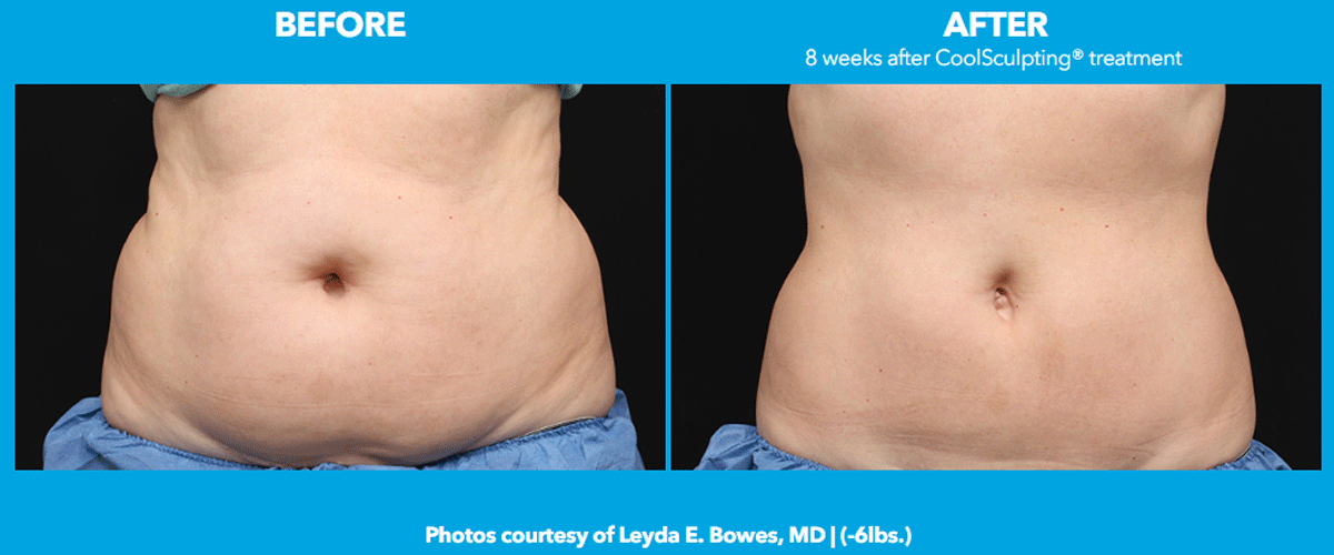 CoolSculpting Before and After