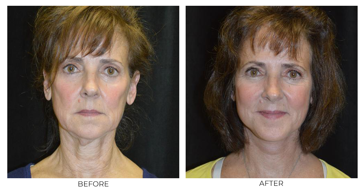 Before and after results from a facelift patient of Dr. Christopher Davidson