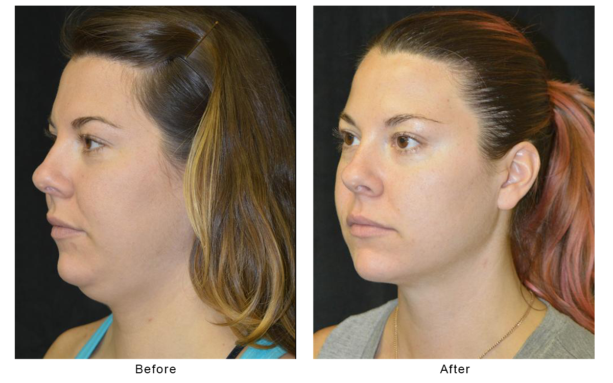 Chin Liposuction Results by Dr. Christopher Davidson
